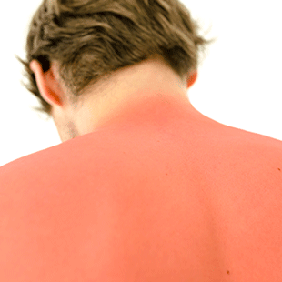 You should wear sunscreen.